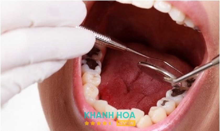 Hình minh họa trám răng sâu tại H Dentis