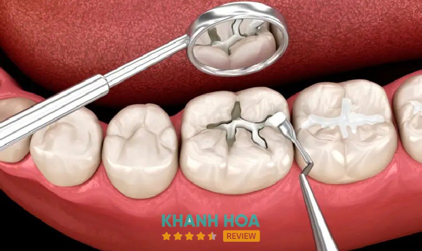 Hình minh họa trám răng tại Nha Khoa Gia Đình