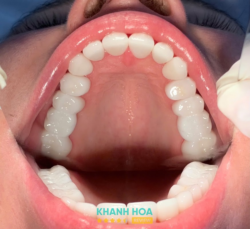 Nha Khoa Opal Vĩnh Điềm Trung – hình ảnh 2