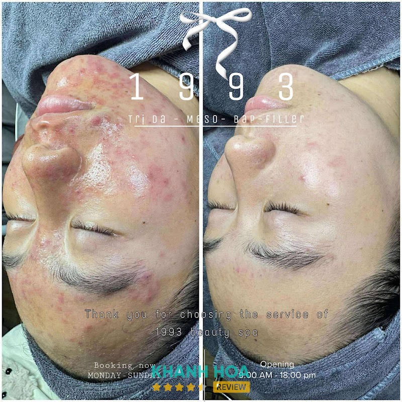 1993 Spa Chuyên điều trị Da Ninh Diêm – hình ảnh 2