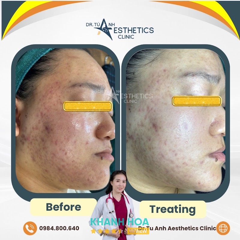 Bác Sĩ Tú Anh Spa & Clinic | Trị mụn Nha Trang – hình ảnh 3